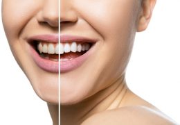 Steps To Safe Teeth Whitening