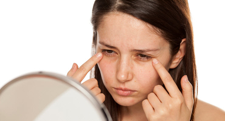 What Are Dark Circles and Why Do You Get Them?